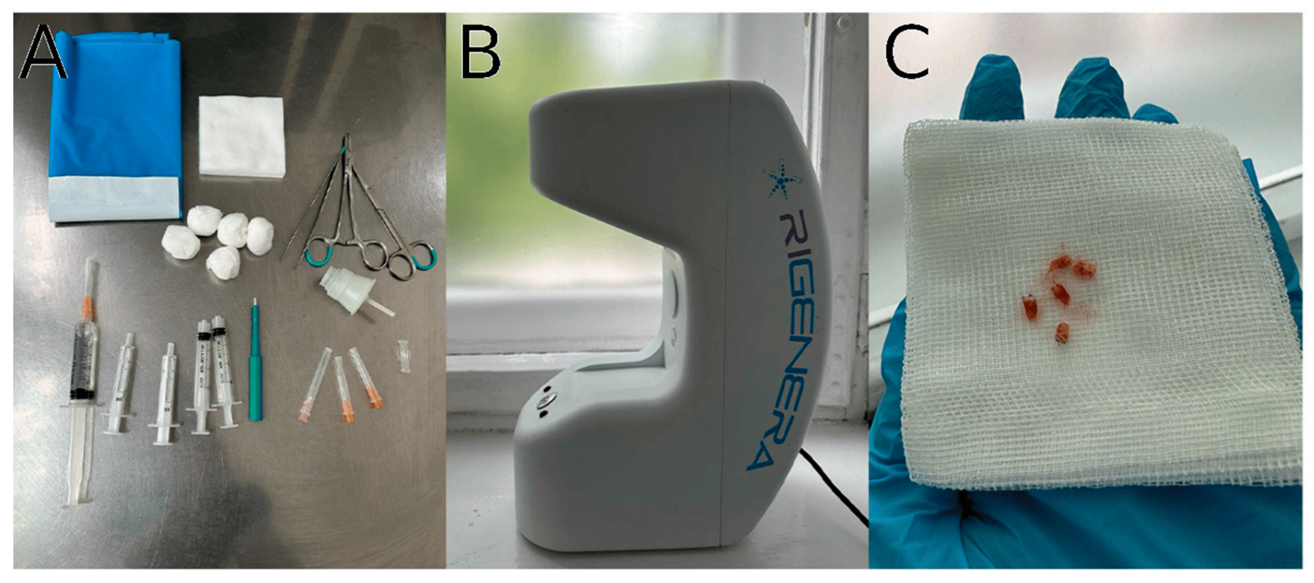 圖1：自體細(xì)胞微移植治療方案要素。