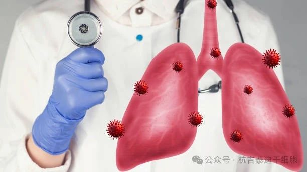 干細(xì)胞療法如何減緩肺部疾病的癥狀？