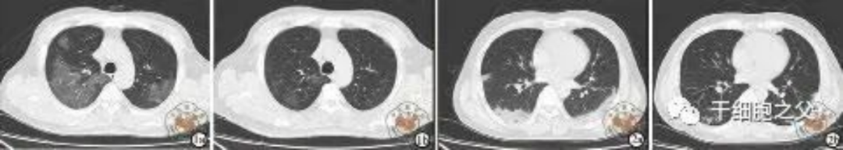 細(xì)胞輸注后，炎癥指標(biāo)改善，復(fù)查胸部CT提示雙肺病灶較前吸收，呼吸道癥狀改善，新型冠狀病毒核酸檢測連續(xù)2次陰性，治愈出院。