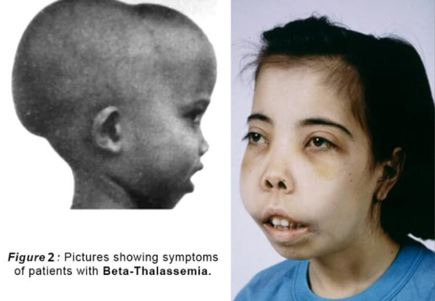 重型β地中海貧血是一種嚴(yán)重的遺傳性疾病，給患兒帶來(lái)了長(zhǎng)期的痛苦和折磨