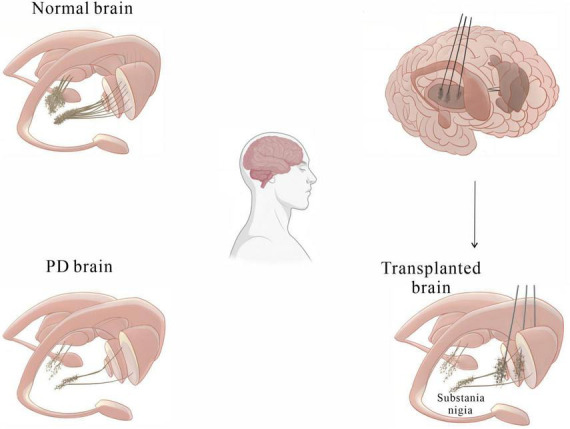 圖2：基本圖顯示細(xì)胞移植療法如何緩解帕金森病患者的運(yùn)動(dòng)癥狀。
