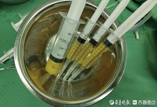 孫濤主任采用的自體脂肪微片段治療術(shù)，為她的治療帶來了新的轉(zhuǎn)機(jī)