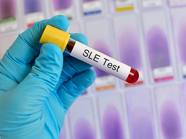 羊膜干細(xì)胞移植在系統(tǒng)性紅斑狼瘡中的應(yīng)用前景 羊膜干細(xì)胞移植在系統(tǒng)性紅斑狼瘡中的應(yīng)用前景