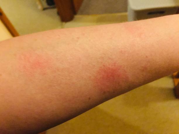 系統(tǒng)性紅斑狼瘡的最佳治療方法是什么？