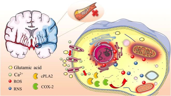 高血壓、高脂血癥、高同型半胱氨酸血癥、高血糖、吸煙和酗酒等危險(xiǎn)因素都可能引發(fā)缺血性中風(fēng)的發(fā)生。
