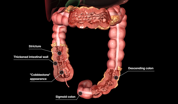 △克羅恩病3D圖示，來源：默沙東診療手冊