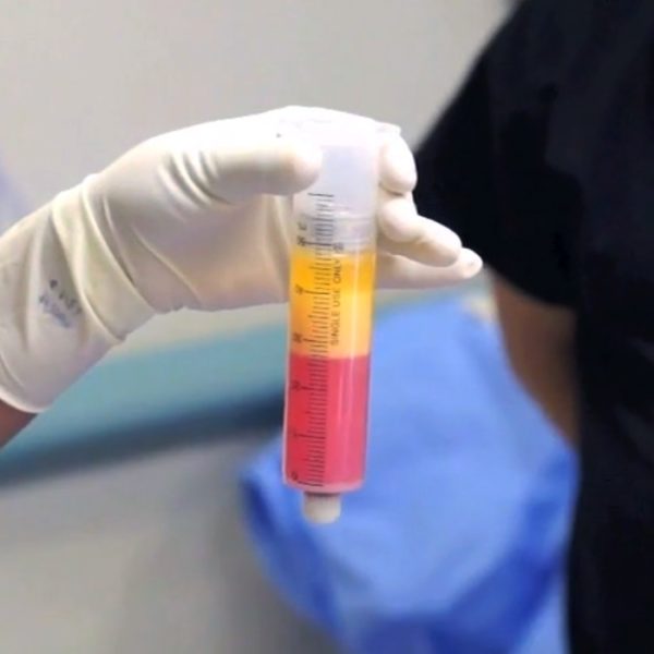 購買和使用低溫保存（冷凍）的臍帶干細(xì)胞是許多干細(xì)胞治療提供者的另一種流行選擇。