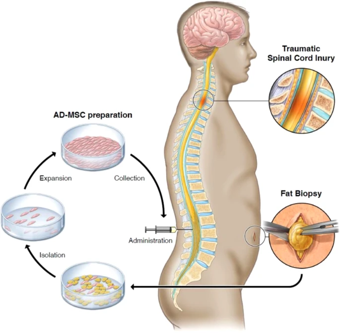 通過活檢、AD-MSC 分離、擴(kuò)增和收集以及治療管理來獲取脂肪的過程圖解