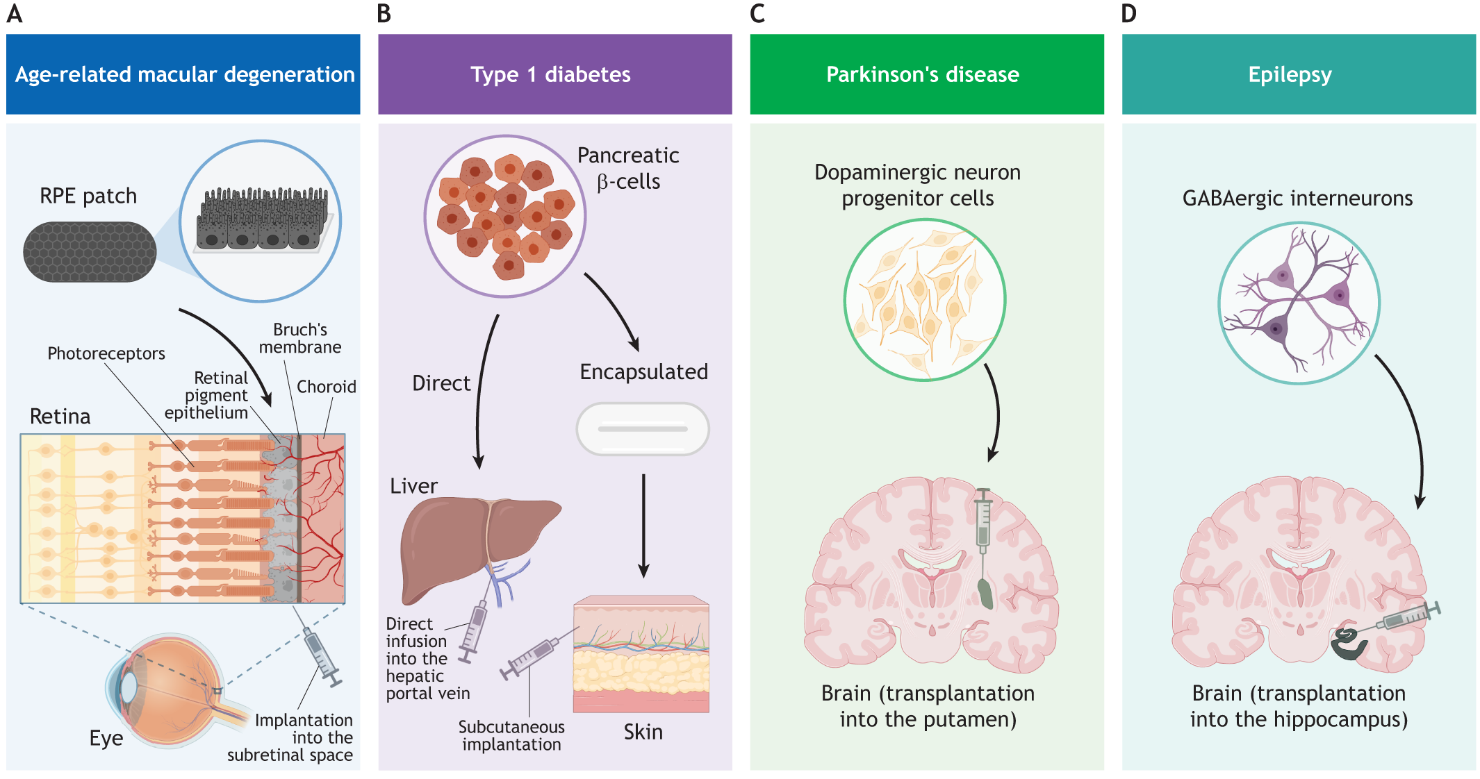 圖2：使用hPSC衍生細(xì)胞產(chǎn)品進行開創(chuàng)性臨床試驗時所涉及的細(xì)胞類型和注射部位的圖示。