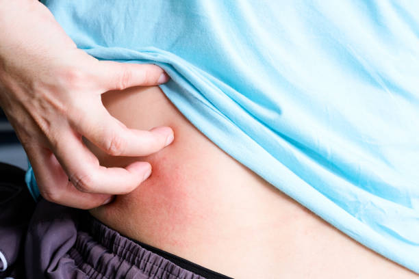 肝硬化肝腎綜合征的診斷、預(yù)防和治療