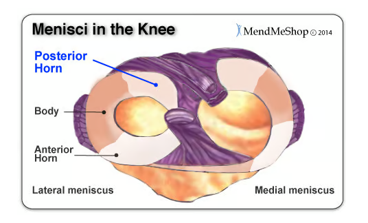 后角半月板撕裂癥狀、原因以及治療方法