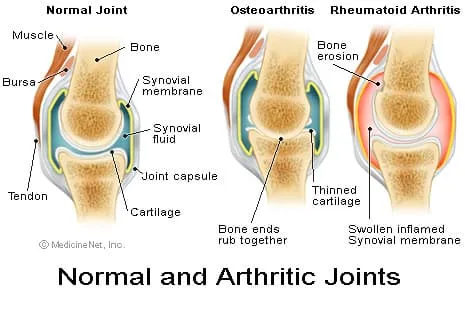 骨關(guān)節(jié)炎：你真的了解是什么導(dǎo)致你的關(guān)節(jié)痛嗎？