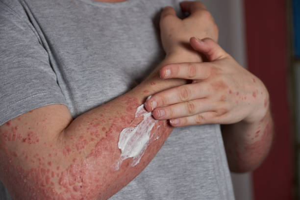 銀屑病的4類治療方式和用藥類型，你都清楚嗎？