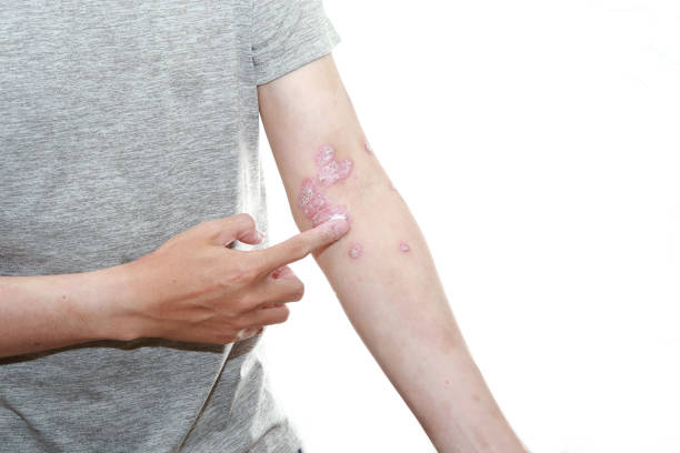 預(yù)防銀屑病發(fā)作的10個(gè)技巧，你都了解嗎？