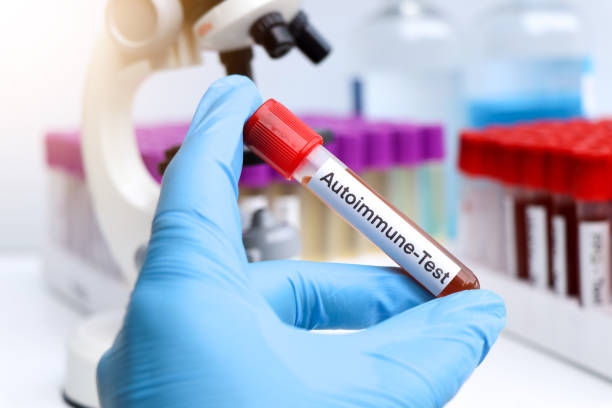 干細(xì)胞在類風(fēng)濕關(guān)節(jié)炎、系統(tǒng)性紅斑狼瘡、銀屑病等自身免疫性疾病中的治療作用