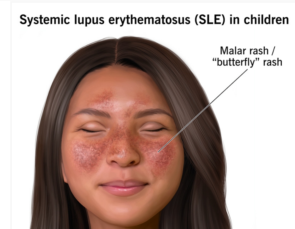 什么是兒童系統(tǒng)性紅斑狼瘡？及其病因和治療方法
