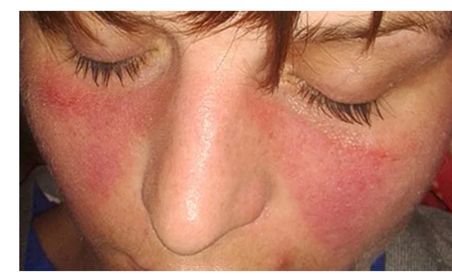 系統(tǒng)性紅斑狼瘡癥狀、病因和治療方法