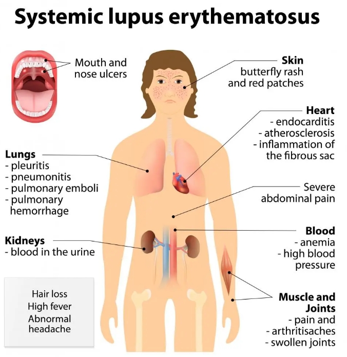 什么是系統(tǒng)性紅斑狼瘡？干細胞治療系統(tǒng)性紅斑狼瘡的臨床案例有哪些?