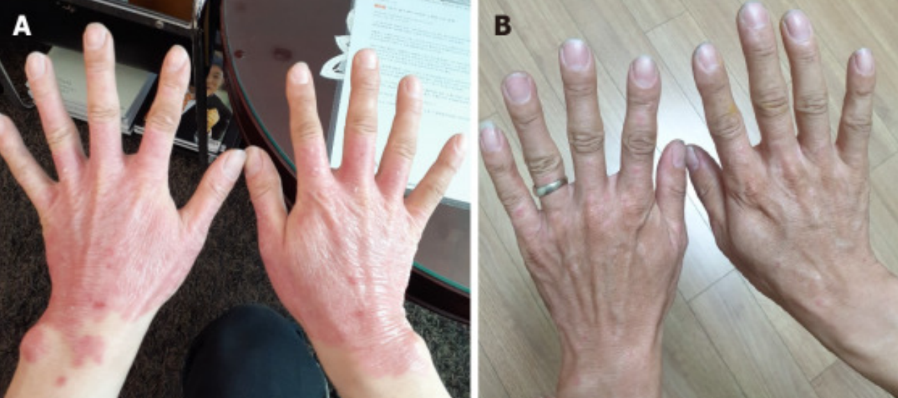 3次干細(xì)胞治療后25年?銀屑病頑疾得到顯著改善！