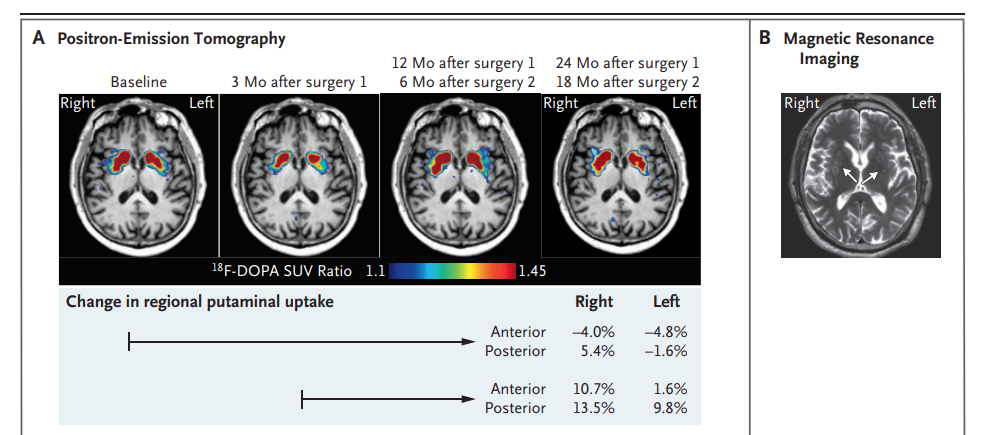 顯示了指示的時(shí)間點(diǎn)在基底神經(jīng)節(jié)水平的軸向氟18-L-二羥基苯丙氨酸（18 F-DOPA）正電子發(fā)射斷層掃描圖像