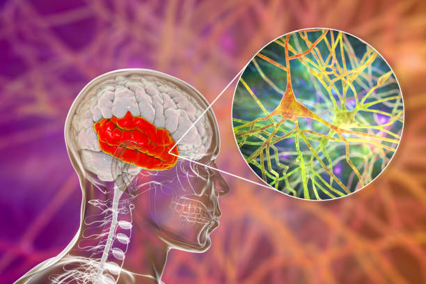 如何治療精神分裂癥？