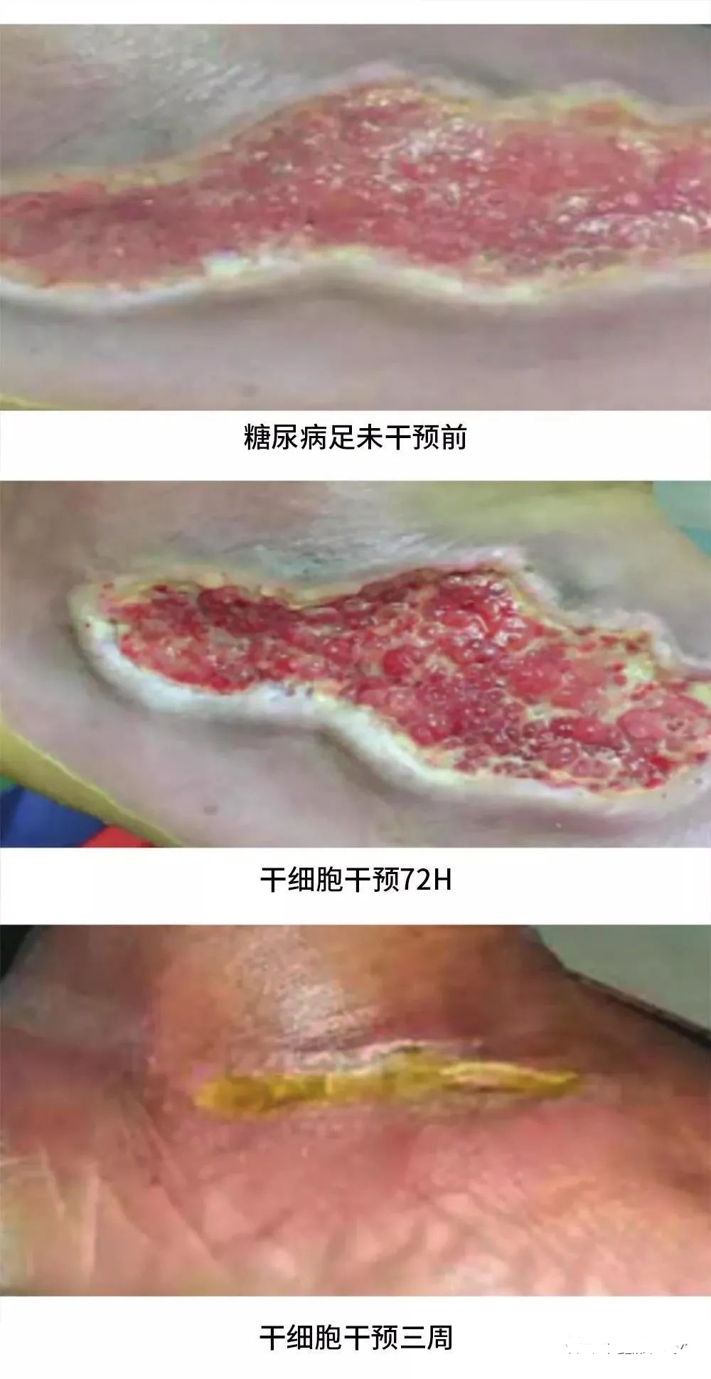 患者治療72小時化膿性分泌物和傷口大小明顯減少，3周后足部潰瘍幾乎愈合，足部行走功能也得到了恢復(fù)。