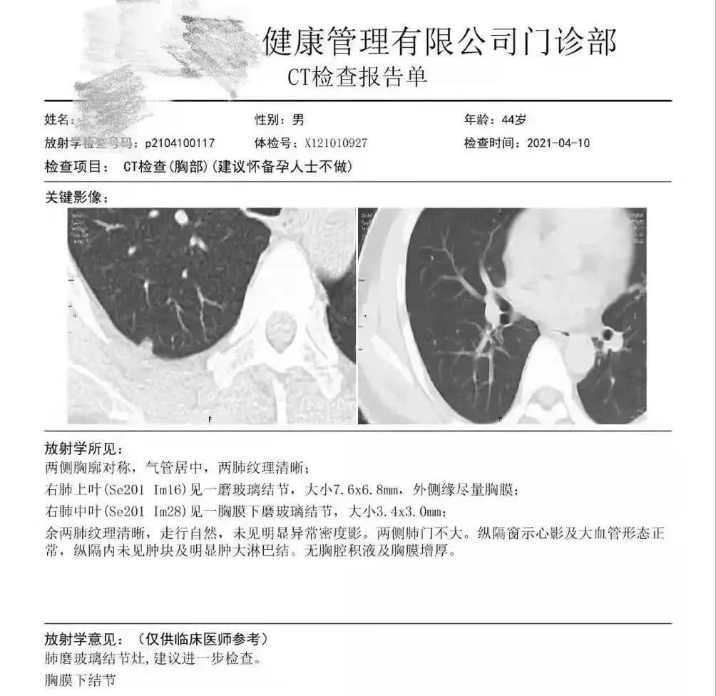 結(jié)果發(fā)現(xiàn)王先生右肺胸膜表面下（肺的內(nèi)部），存在兩枚磨玻璃結(jié)節(jié)，其中較大者直徑7.6mm。