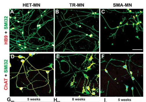 2012年干細胞治療脊髓性肌萎縮癥臨床案例
