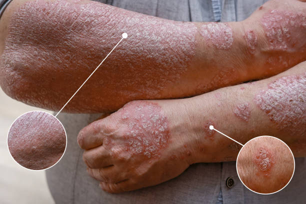 銀屑病治療新策略:干細胞治療銀屑病的臨床應(yīng)用與效果評估 銀屑病治療新策略:干細胞治療銀屑病的臨床應(yīng)用與效果評估