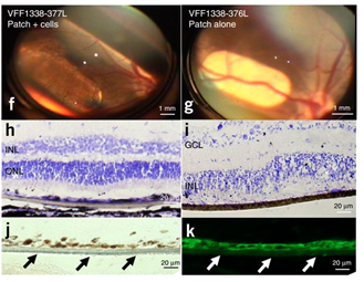 干細胞治療黃斑變性臨床案例 干細胞治療黃斑變性臨床案例