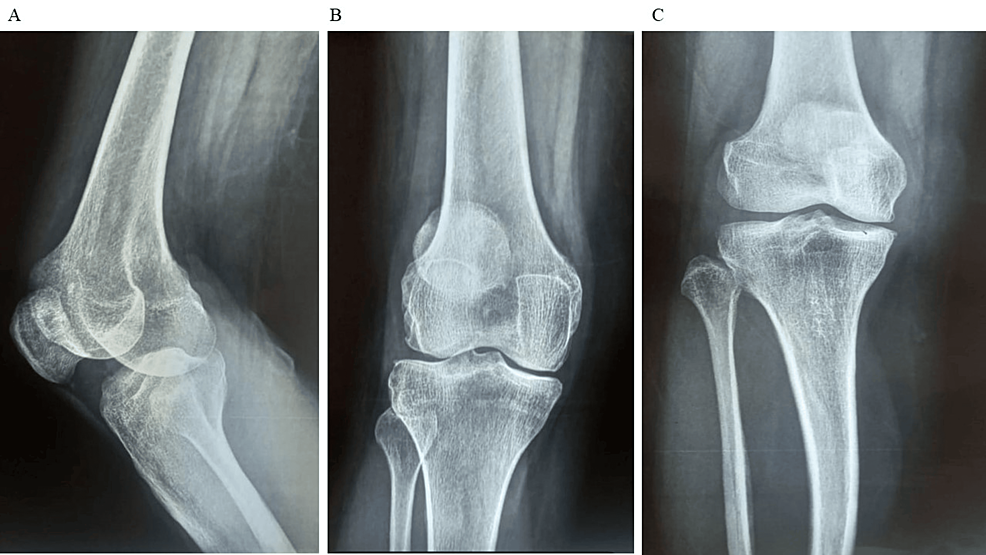 圖1：顯示了開始干細胞治療之前的骨骼側視圖和前后視圖。