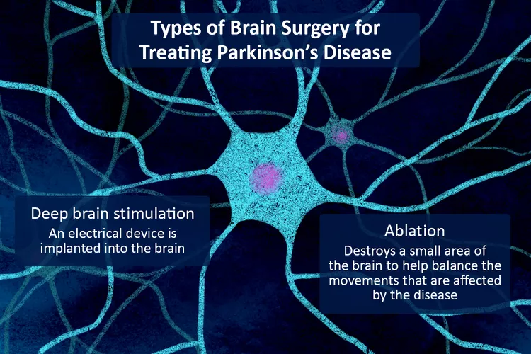 帕金森病的腦部手術(shù)：類型、恢復(fù)和風(fēng)險