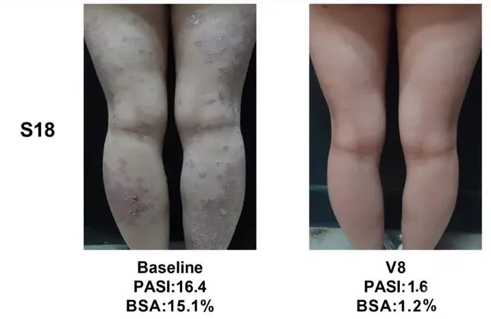 總共47.1% (8/17)的銀屑病患者在PASI(皮損面積和嚴重程度)評分中有至少40%的改善 總共47.1% (8/17)的銀屑病患者在PASI(皮損面積和嚴重程度)評分中有至少40%的改善