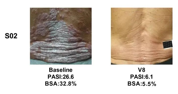 總共47.1% (8/17)的銀屑病患者在PASI(皮損面積和嚴重程度)評分中有至少40%的改善 總共47.1% (8/17)的銀屑病患者在PASI(皮損面積和嚴重程度)評分中有至少40%的改善