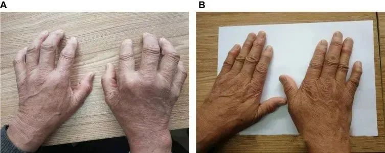 一名68歲男性被診斷患有類風濕性關節(jié)炎治療前后的對比 