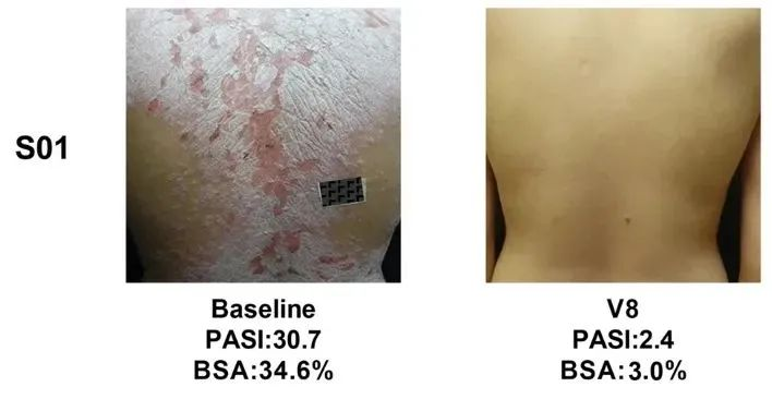 同種異體UMSCs的移植對銀屑病患者安全且部分有效，尤其對女性銀屑病患者