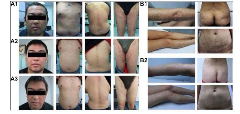 兩例尋常型銀屑病患者通過臍帶間充質(zhì)干細胞（UC-MSCs）治療，兩例患者均在4至5年內(nèi)未復發(fā)。