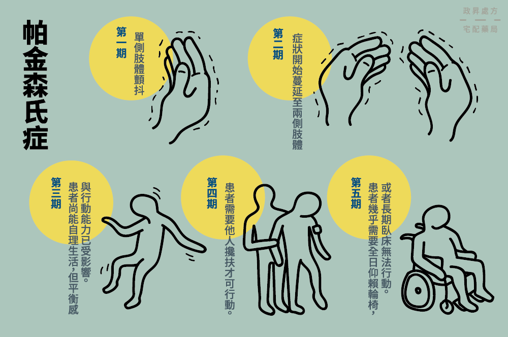 帕金森病的5個階段 帕金森病的5個階段