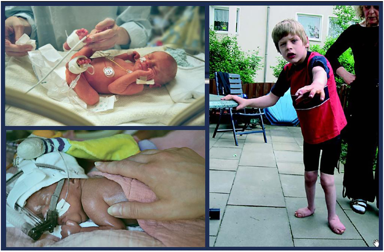 腦癱 (CP) 是兒童期最常見的殘疾，是一種嚴(yán)重的非進(jìn)行性嬰幼兒腦部疾病，具有終身后遺癥