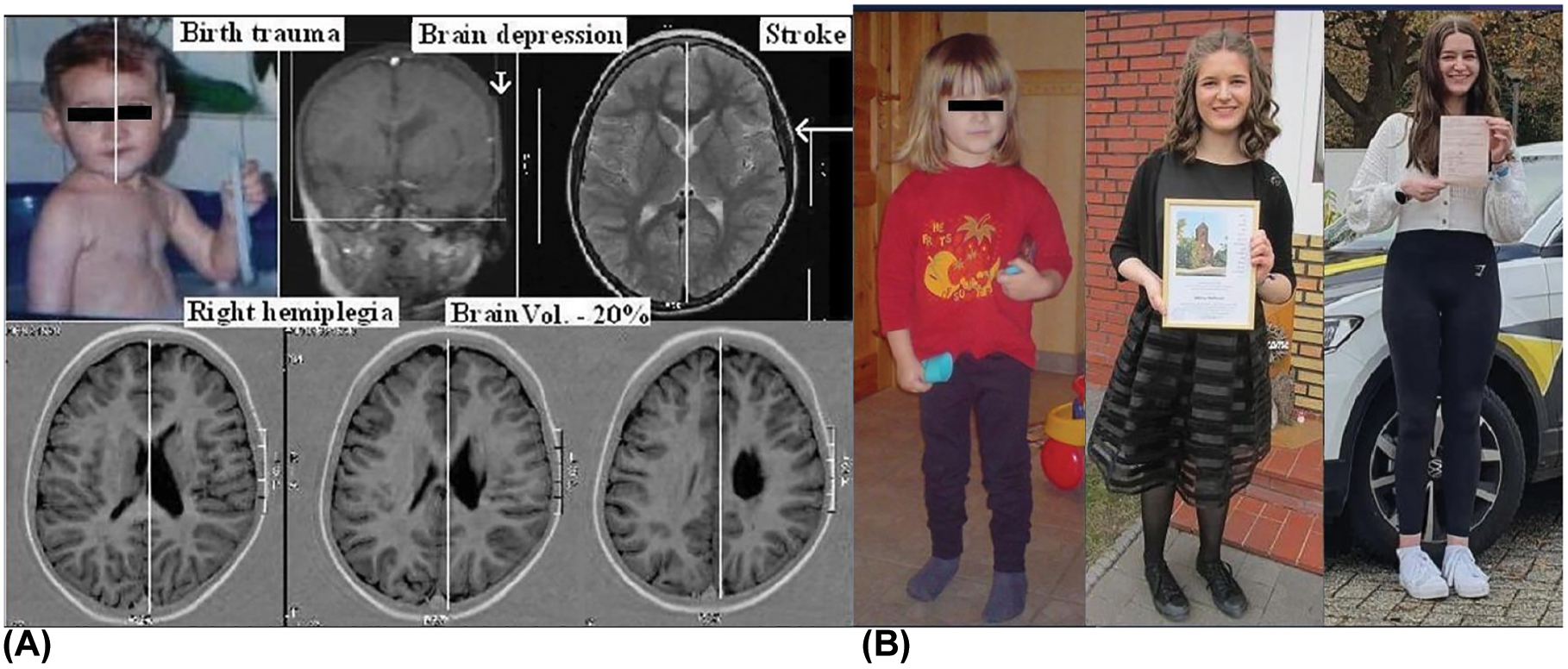 創(chuàng)傷是先天性腦癱的危險因素