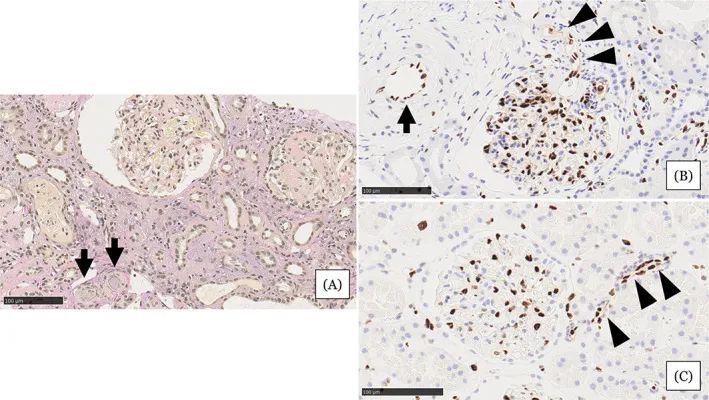 在住院第31天進(jìn)行的腎活檢結(jié)果