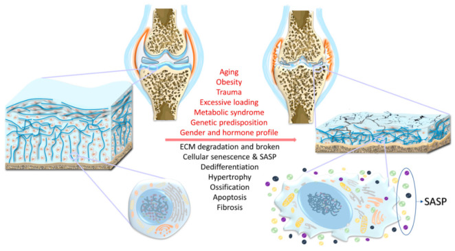 圖1：骨關(guān)節(jié)炎（OA）的風(fēng)險(xiǎn)因素、結(jié)構(gòu)改變和軟骨細(xì)胞特異性變化。