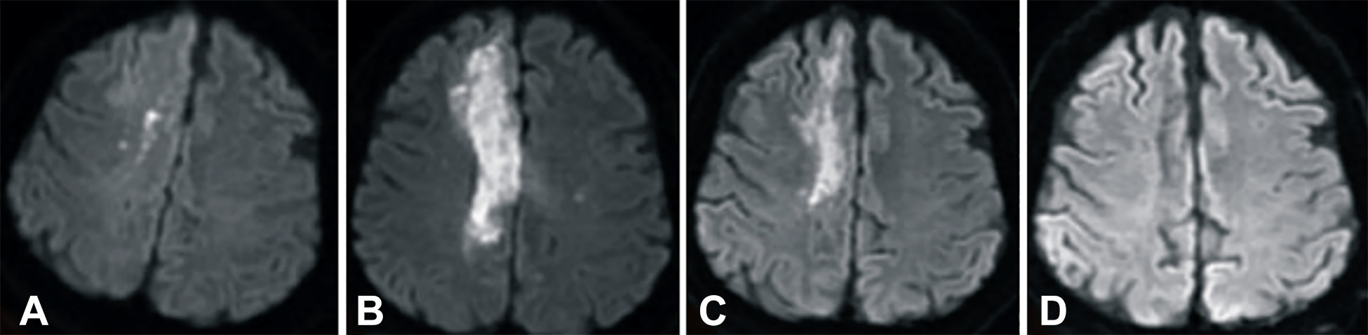 卒中發(fā)病后2小時和單核細(xì)胞臍帶血輸注后6個月獲得的彌散加權(quán)圖像