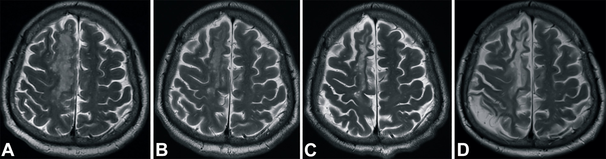 中風(fēng)后2小時和輸血后6個月獲得的T2加權(quán)圖像。