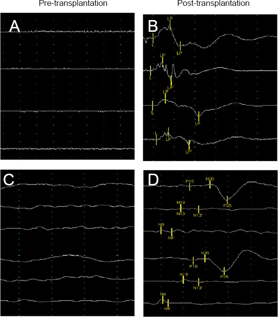 神經(jīng)電生理學改善