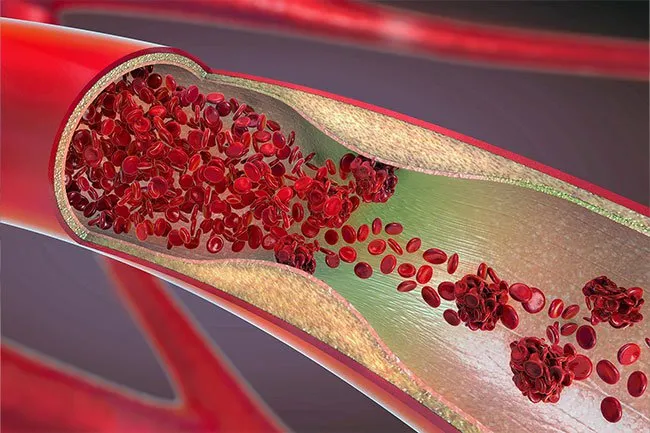 高膽固醇 高膽固醇