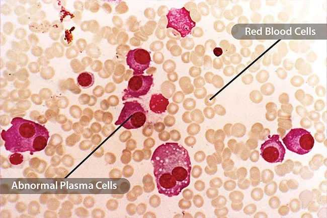 多發(fā)性骨髓瘤 多發(fā)性骨髓瘤