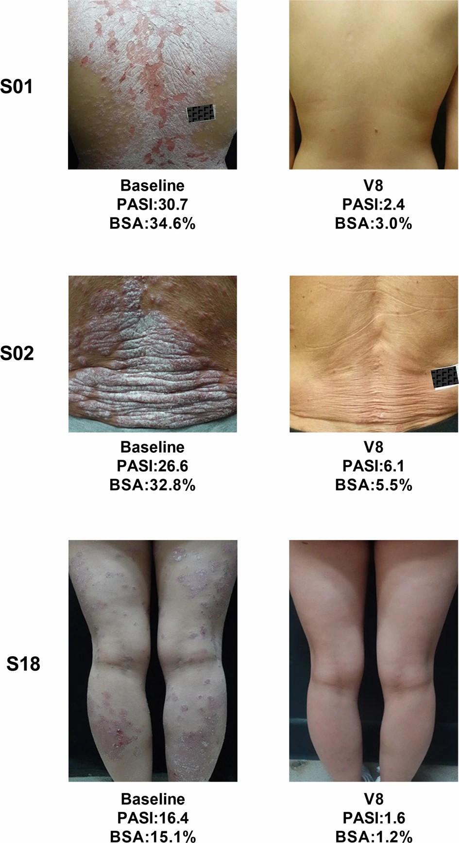 三名患者經(jīng)過治療后根據(jù) PGA 評分顯示無疾病跡象（評分為 0）或輕微疾?。ㄔu分為 1）。