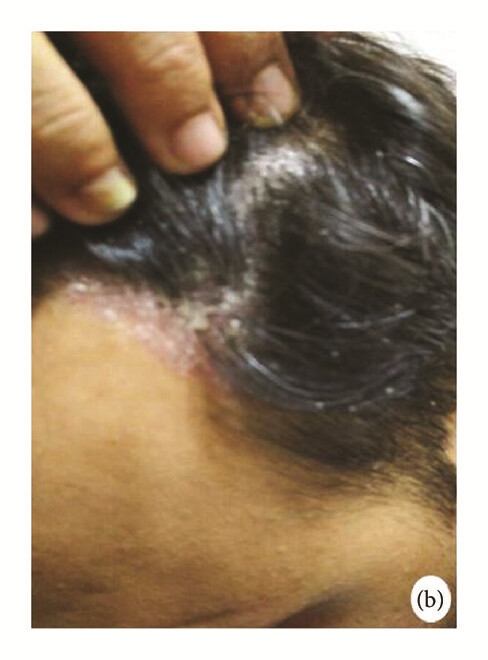 骨髓間充質(zhì)干細(xì)胞 治療前，患者頭皮上出現(xiàn)大量紅斑，并附著銀色鱗片（b）。