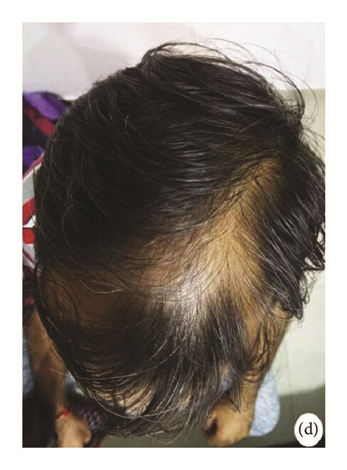 局部應(yīng)用骨髓間充質(zhì)干細(xì)胞一個(gè)月后，銀屑病消退，炎性紅斑完全清除（d）。